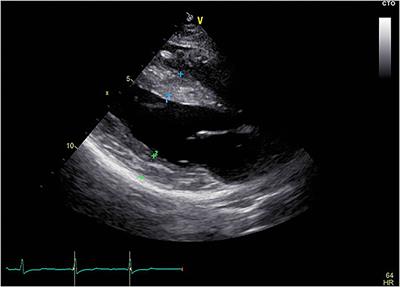 De novo LAMP2 insertion mutation causes cardiac-only Danon disease: A case report